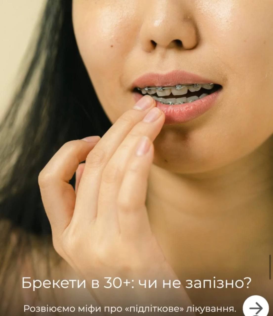 Брекети у дорослому віці: ортодонтичне лікування після 30 років